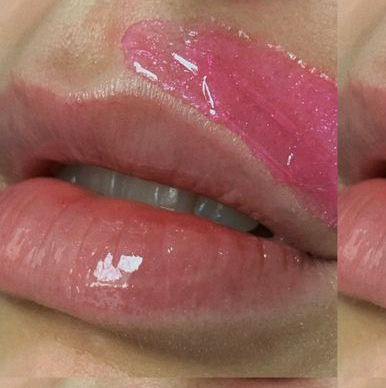 Депиляция зоны лица (лоб, бакенбарды, пушок, подбородок, щеки, шея)