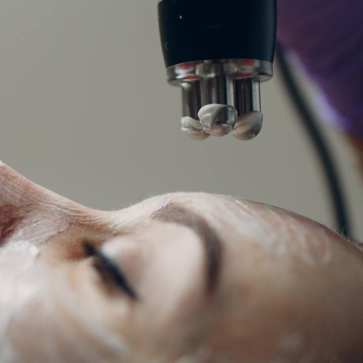 RF лифтинг вокруг глаз+скулы