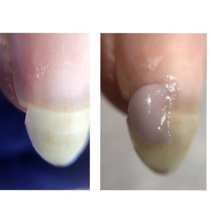 Repair of 1 Nail (Partial, Full)