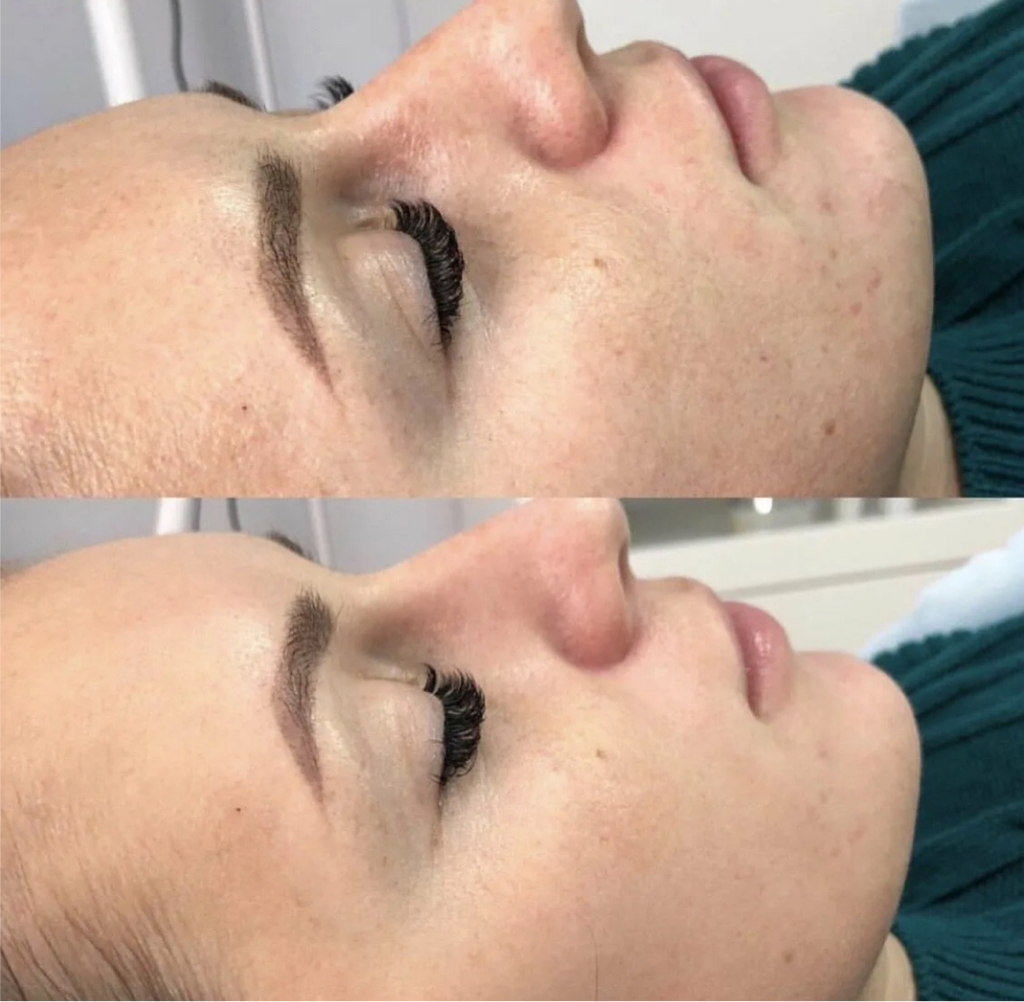 Пилинг поверхностный