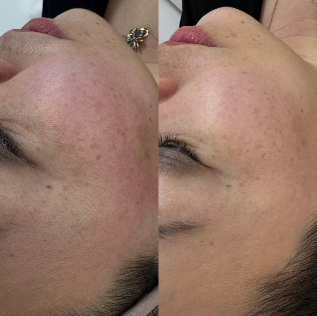 Чистка лица