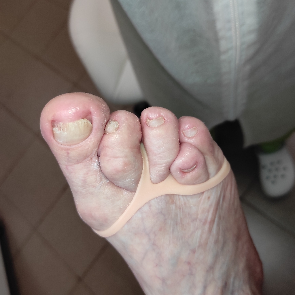 Подологическая обработка только пальцев ног без покрытия