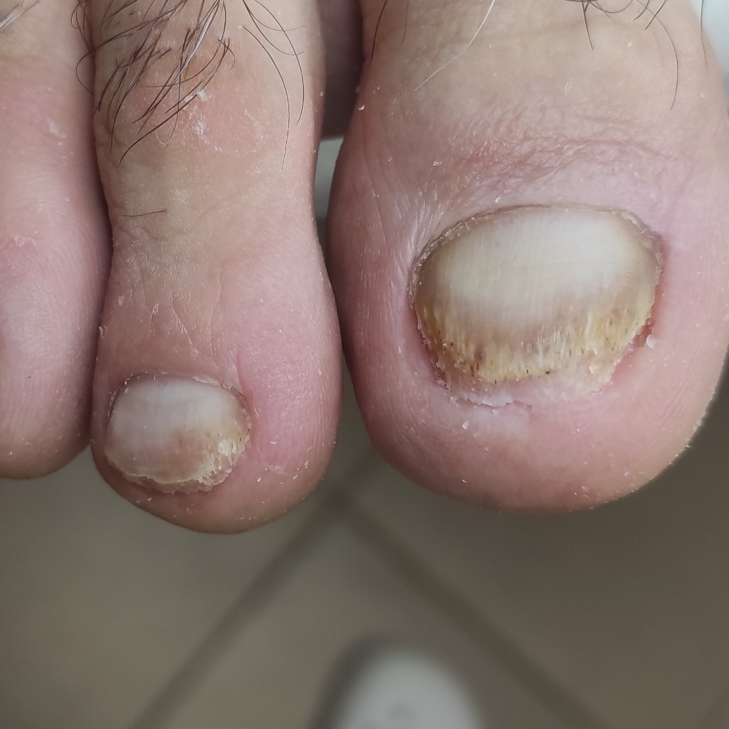 Обработка онихолизиса, онихогрифоза или микоза на ногах 2-3 ногтя