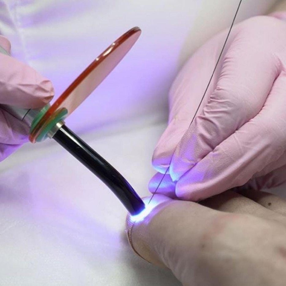 Установка титановой нити 6-10 ноготей