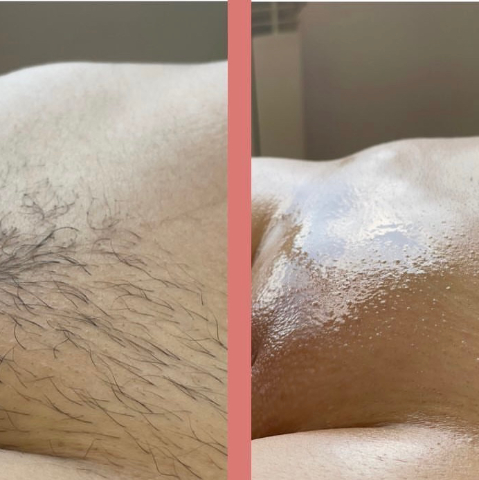 Депиляция  КОМБО MEDIUM:   ГЛУБОКОЕ БИКИНИ + ПОДМЫШКИ+НОГИ ДО КОЛЕН