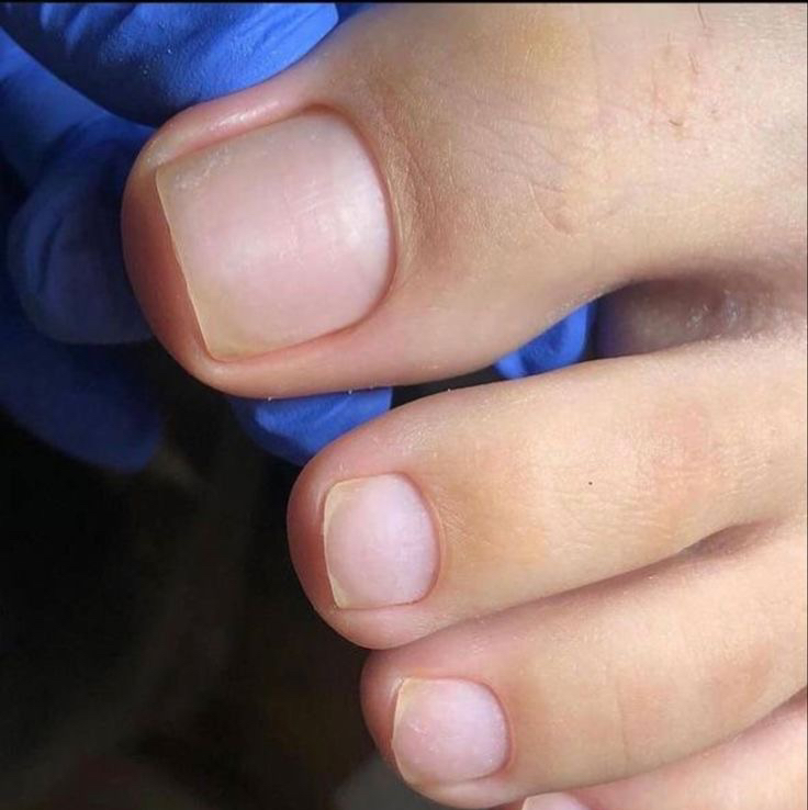 Педикюр обработка пальчиков