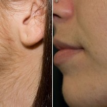 Губа,подбородок,виски,уши