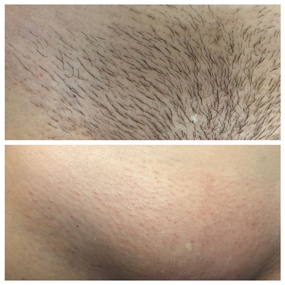 Глубокое бикини