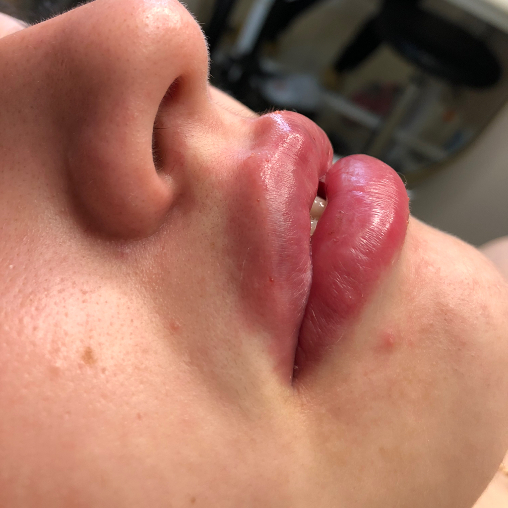 Контурная пластика